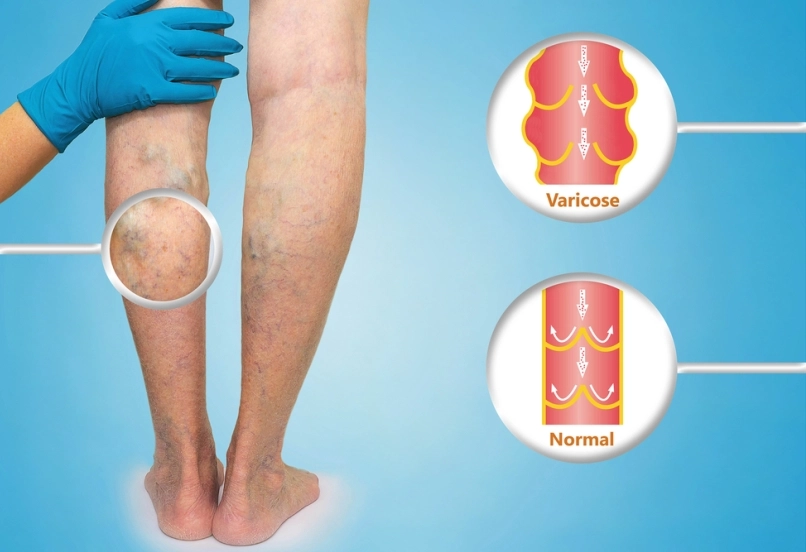Venaseal Varicose Veins Surgery